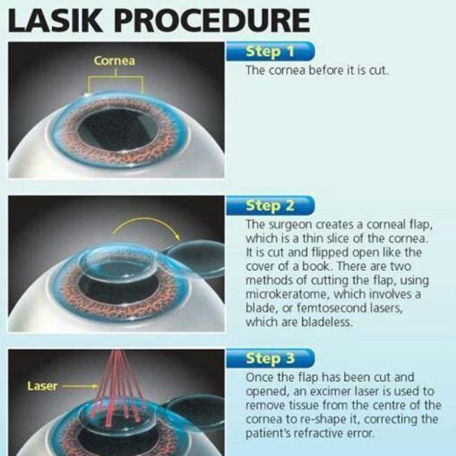 Lasik for Shelby