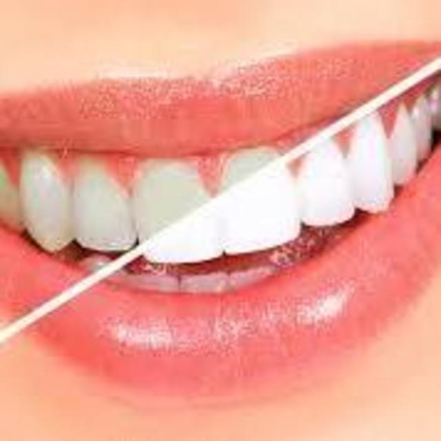 Pre-Wedding Teeth Whitening